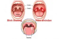 Viêm amidan - Bệnh viện 108