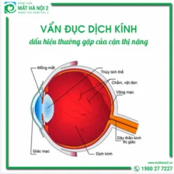 VẨN ĐỤC DỊCH KÍNH: dấu hiệu thường gặp của cận thị nặng