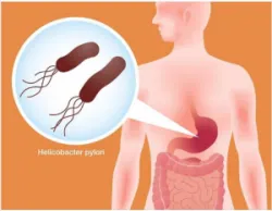 VI KHUẨN HP - MỐI NGUY VỚI CHÍNH BẠN, GIA ĐÌNH BẠN VÀ CỘNG ĐỒNG