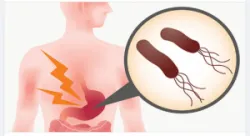 VI KHUẨN H- THỦ PHẠM GÂY RA NHỮNG BỆNH LÝ NGUY HIỂM NÀO?