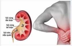 VÌ SAO SỎI THẬN, SỎI TIẾT NIỆU GÂY ĐAU ĐỚN?