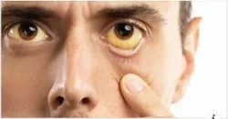 TOP 10 TRIỆU CHỨNG BỆNH GAN CÓ THỂ KHIẾN BẠN GIẬT MÌNH