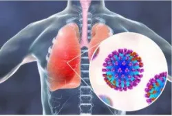 "ĐIỂM TÊN" CÁC BỆNH LÝ ĐƯỜNG HÔ HẤP THƯỜNG GẶP KHI GIAO MÙA XUÂN - HÈ