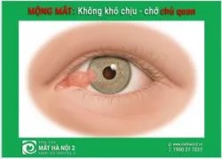 MỘNG MẮT: Không khó chịu nhưng chớ chủ quan