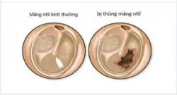 THỦNG MÀNG NHĨ VÀ NHỮNG ĐIỀU CẦN BIẾT