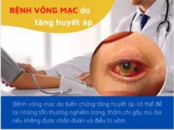 CẢNH GIÁC BIẾN CHỨNG VÕNG MẠC DO TĂNG HUYẾT ÁP