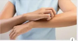 NỖI ÁM ẢNH VỚI BỆNH VIÊM DA CƠ ĐỊA