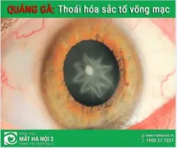 QUÁNG GÀ: Thoái hóa sắc tố võng mạc