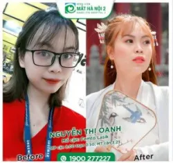 FEMTO LASIK - Phương pháp mổ cận được nhiều người lựa  chọn