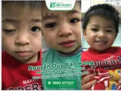 PHẪU THUẬT THÀNH CÔNG CA SỤP MI BẨM SINH CHO BỆNH NHÂN NHÍ 3 TUỔI