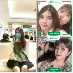 2 CHỊ EM CÙNG ĐI MỔ CẬN TẠI MẮT HÀ NỘI 2