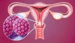 Vắc-xin HPV: Ai nên tiêm và tiêm khi nào?