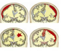 Chụp cắt lớp vi tính sọ não có dựng hình 3D