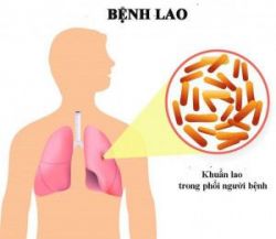 Triệu chứng của bệnh AIDS