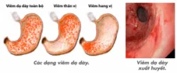 Xét nghiệm BUN là gì? Ý nghĩa xét nghiệm BUN
