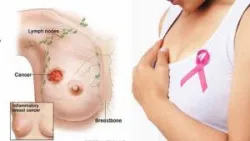 Nhận biết một số bệnh lành tính phổ biến ở tuyến vú