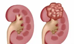 Phân biệt thận đa nang và nang thận