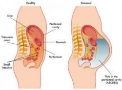 Xử trí khi bị tràn dịch màng bụng