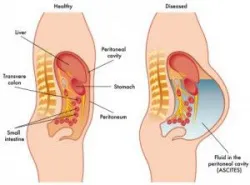 Chọc hút dịch màng bụng: Những điều cần biết