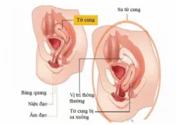 Nguyên nhân và biểu hiện sa tử cung