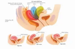Bạn bị sa tử cung ở mức độ nào?