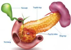 Tìm hiểu hiện tượng triglyceride máu trong viêm tụy cấp