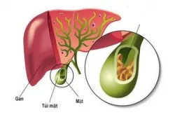 Vì sao túi mật bị xẹp?