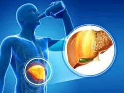 6 lầm tưởng về bệnh gan nhiễm mỡ