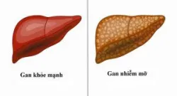 Chẩn đoán và điều trị gan nhiễm mỡ