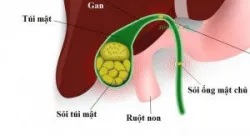 Phòng ngừa sỏi ống mật chủ tái phát sau mổ