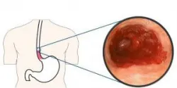 Các vấn đề thường gặp ở thực quản