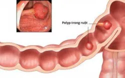 Các loại polyp đại trực tràng thường gặp