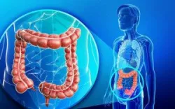Chẩn đoán xác định hội chứng ruột kích thích
