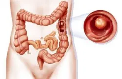 Lưu ý sau phẫu thuật cắt polyp đại tràng