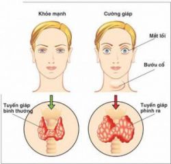 Dấu hiệu cảnh báo các vấn đề về tuyến giáp