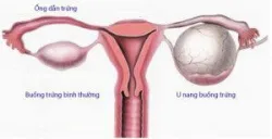Tổng quan về buồng trứng