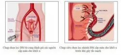 U xơ tử cung kích thước thế nào có thể nút mạch, không cần mổ?