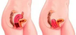 Vòng nâng cổ tử cung trong điều trị bệnh lý sàn chậu