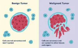 Liquid Biopsy - Sinh thiết lỏng trong chẩn đoán và tầm soát ung thư: những hứa hẹn và thách thức