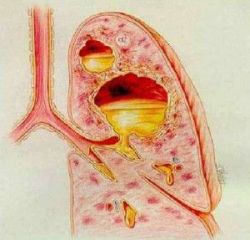 Những tổn thương cơ bản ở bệnh phổi phát hiện trên X quang