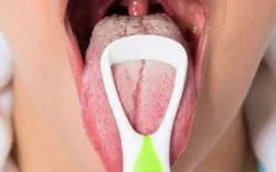 Chứng lưỡi lông đen: Những điều cần biết