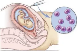 Nhiễm sắc thể 18, Monosomy 18p