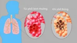 Ứng dụng lâm sàng của Tế bào gốc trung mô dây rốn trong điều trị phổi tắc nghẽn mạn tính (COPD)