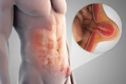 Thoát vị thành bụng có nguy hiểm?