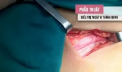 Điều trị thoát vị thành bụng sau mổ