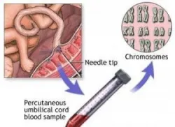 Chọc hút máu cuống rốn trong chẩn đoán trước sinh