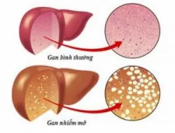 Bệnh gan nhiễm mỡ không do rượu