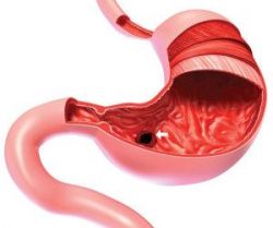 Viêm loét nông hang vị là gì? Nguyên nhân và triệu chứng