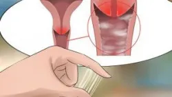 Dấu hiệu viêm âm đạo do vi khuẩn