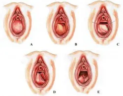 Mổ vách ngăn mở thông âm đạo